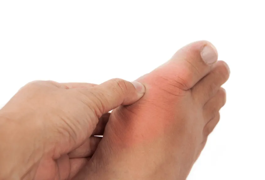 Patients with gout or hyperuricemia Patients with gout or hyperuricemia